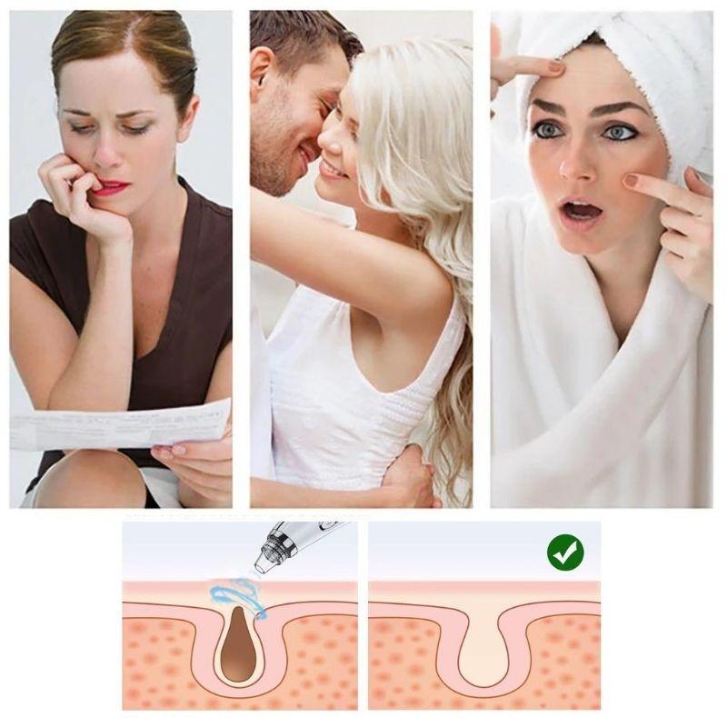 Vacuum Blackhead Remover